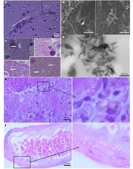 ▲ 사망자의 뇌 조직에서 발견된 플라스틱 입자. (e, f) 치매 환자의 뇌 조직에서는 더 많은 반사성 입자들이 면역세포 주변(e)과 뇌혈관 벽(f)에 집중적으로 존재하는 것이 관찰되었다.ⓒ네이처 메디신